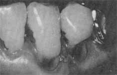 虫歯や歯周炎から歯を守るブラッシング