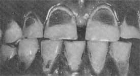 虫歯や歯周炎から歯を守るブラッシング